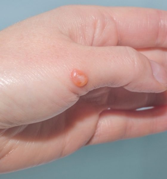 Unveiling the Mysteries of Blisterata: A Journey Through the World of Blisters