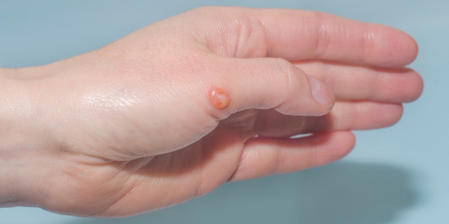 Unveiling the Mysteries of Blisterata: A Journey Through the World of Blisters